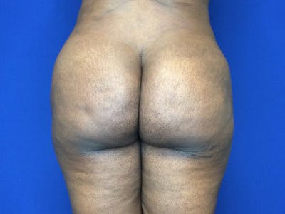 Brazilian Butt Lift Before & After Gallery - Patient 144197137 - Image 2