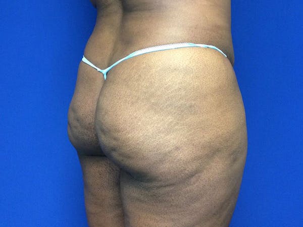 Brazilian Butt Lift Before & After Gallery - Patient 144197137 - Image 9