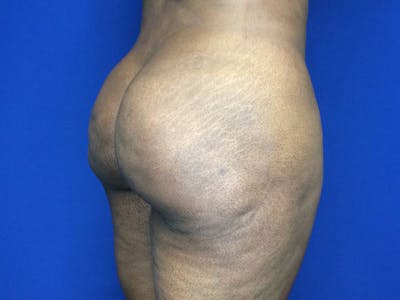 Brazilian Butt Lift Before & After Gallery - Patient 144197137 - Image 10
