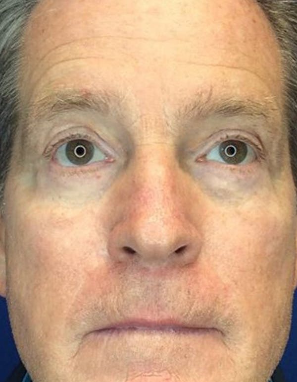 Blepharoplasty Before & After Gallery - Patient 144315417 - Image 2