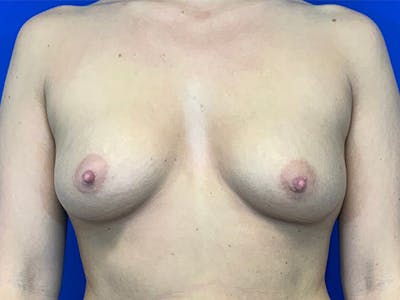 Breast Augmentation Before & After Gallery - Patient 144404311 - Image 1
