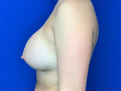 Breast Augmentation Before & After Gallery - Patient 144404311 - Image 4