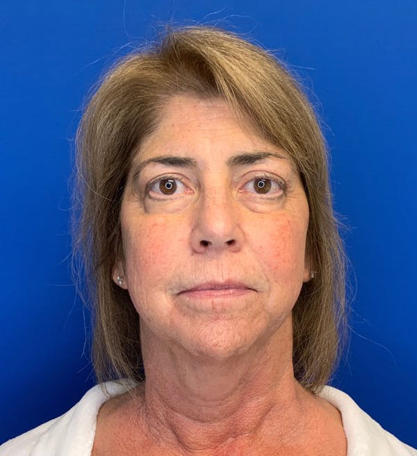 Neck Lift Before & After Gallery - Patient 144404346 - Image 1