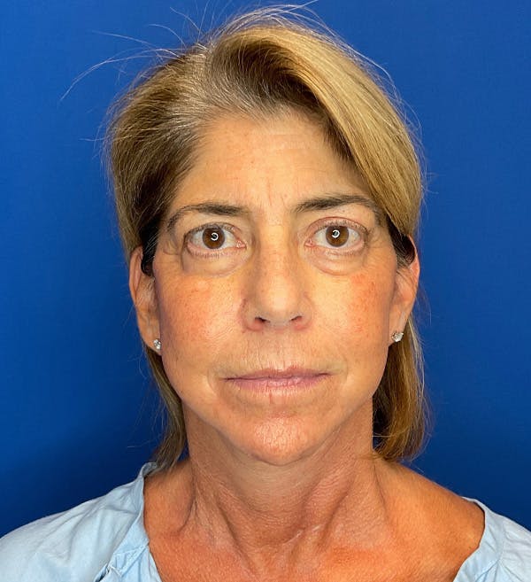 Neck Lift Before & After Gallery - Patient 144404346 - Image 2
