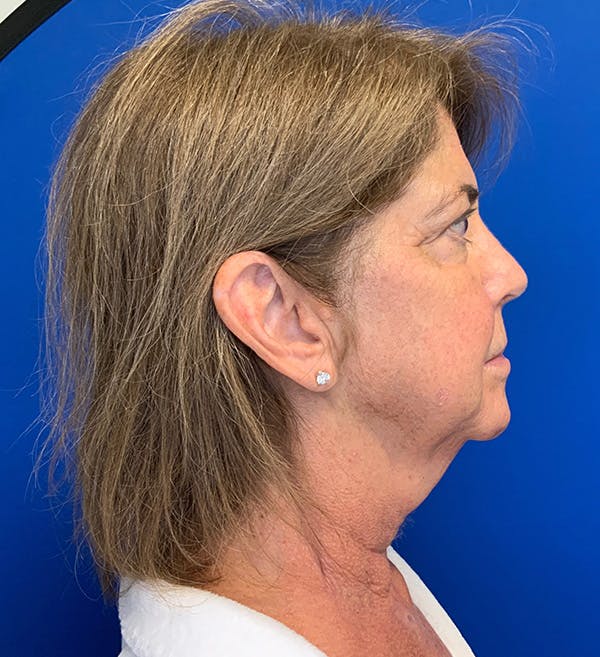 Neck Lift Before & After Gallery - Patient 144404346 - Image 3