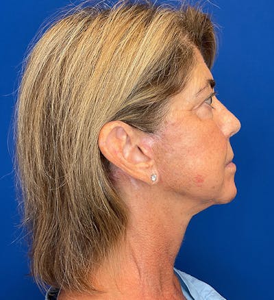 Neck Lift Before & After Gallery - Patient 144404346 - Image 4