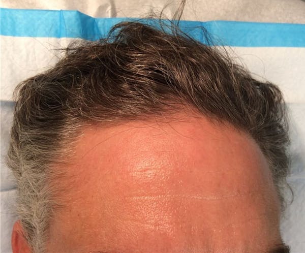 Hair Restoration Before & After Gallery - Patient 149341897 - Image 2