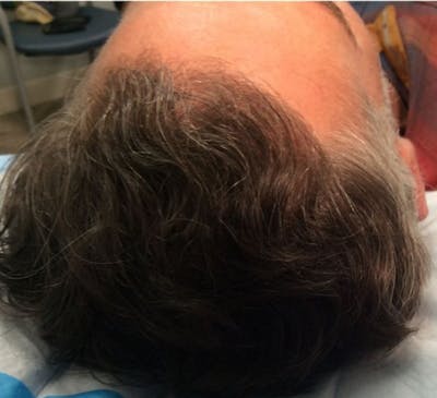 Hair Restoration Before & After Gallery - Patient 149341897 - Image 4