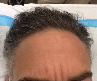 Hair Restoration Before & After Gallery - Patient 149341897 - Image 1