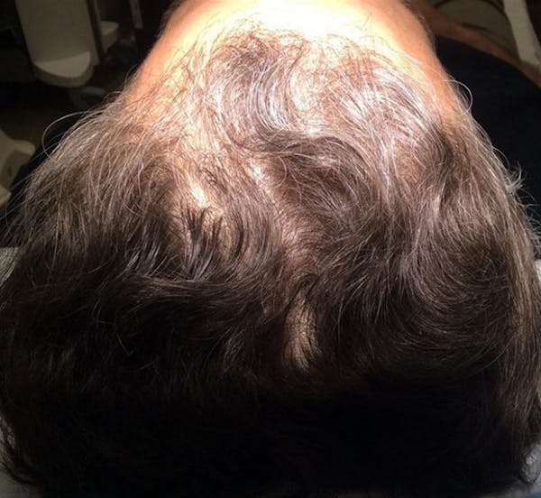 Hair Restoration Before & After Gallery - Patient 149341897 - Image 3