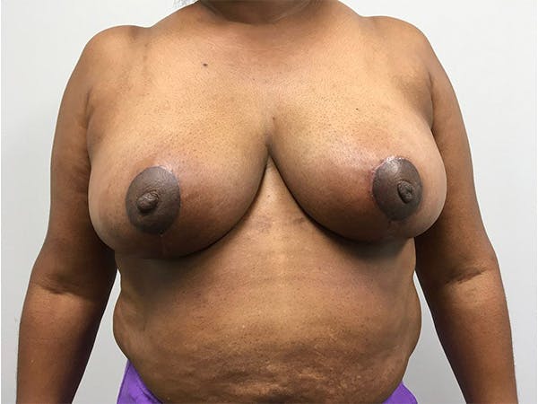 Breast Reduction Before & After Gallery - Patient 144554778 - Image 2