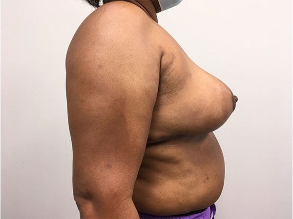 Breast Reduction Before & After Gallery - Patient 144554778 - Image 4