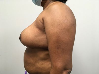 Breast Reduction Before & After Gallery - Patient 144554778 - Image 6