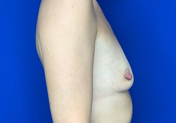 Breast Augmentation Before & After Gallery - Patient 144562235 - Image 3