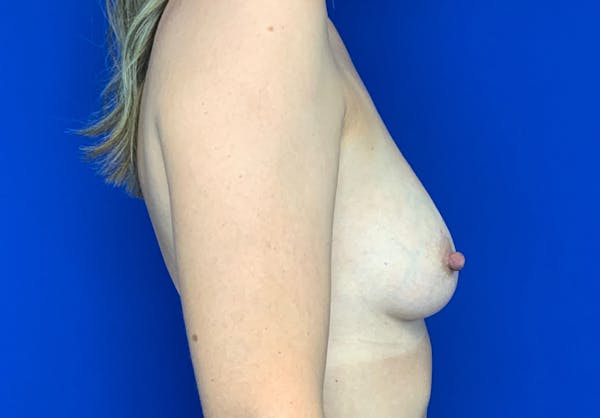 Breast Augmentation Before & After Gallery - Patient 144562235 - Image 4