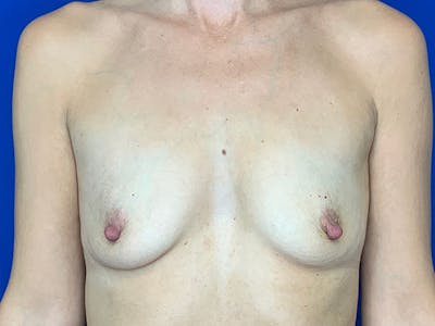 Breast Augmentation Before & After Gallery - Patient 144562235 - Image 1