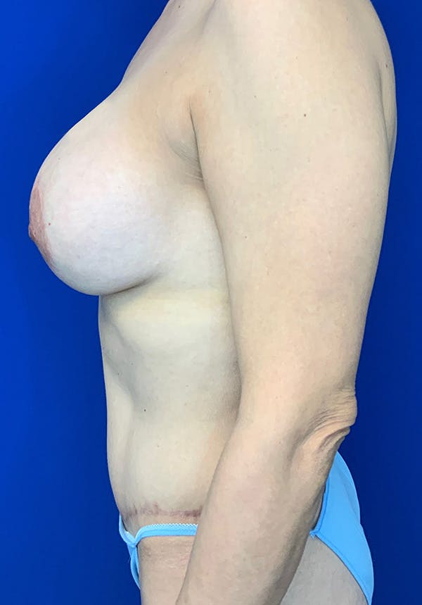 Tummy Tuck (Abdominoplasty) Before & After Gallery - Patient 144562348 - Image 4