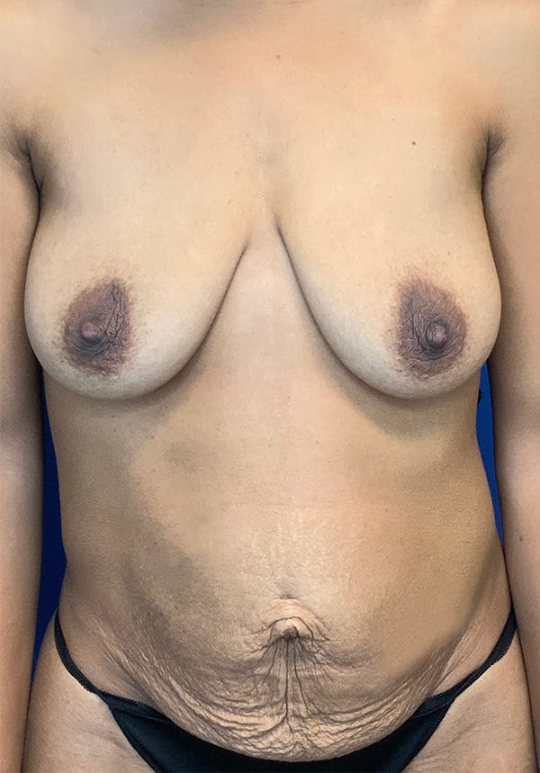 Breast Augmentation Before & After Gallery - Patient 144562378 - Image 1