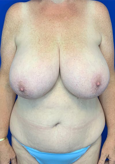 Breast Reduction Before & After Gallery - Patient 144562384 - Image 1
