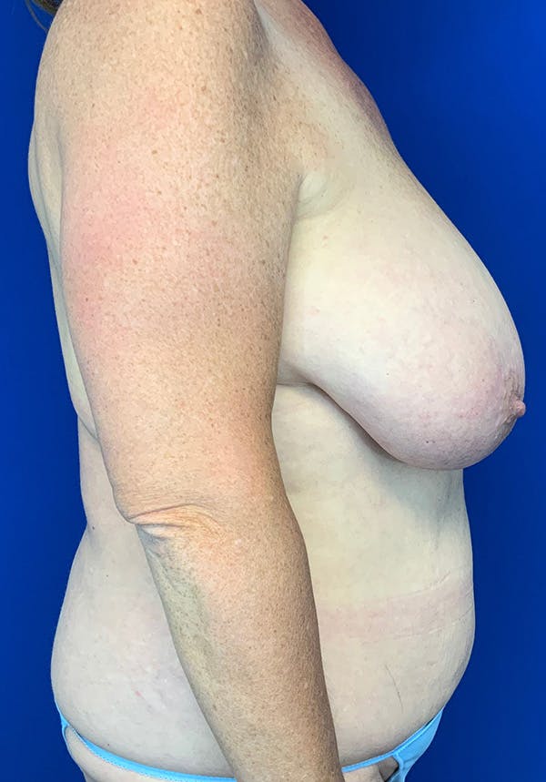 Liposuction Before & After Gallery - Patient 144562383 - Image 3