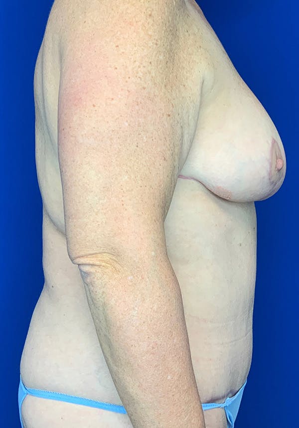 Breast Reduction Before & After Gallery - Patient 144562384 - Image 4