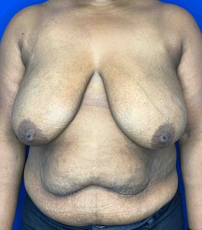 Breast Reduction Before & After Gallery - Patient 144562390 - Image 1