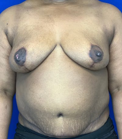 Liposuction Before & After Gallery - Patient 144562389 - Image 2