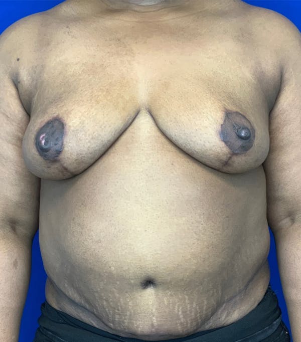 Tummy Tuck (Abdominoplasty) Before & After Gallery - Patient 144562388 - Image 2