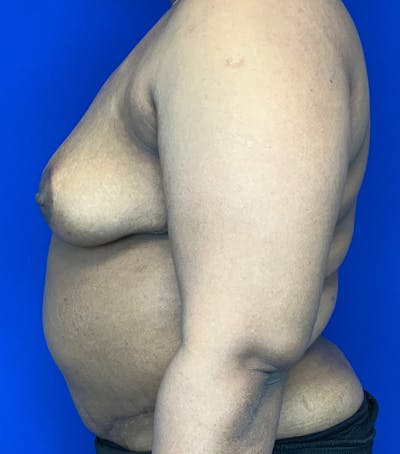 Liposuction Before & After Gallery - Patient 144562389 - Image 4
