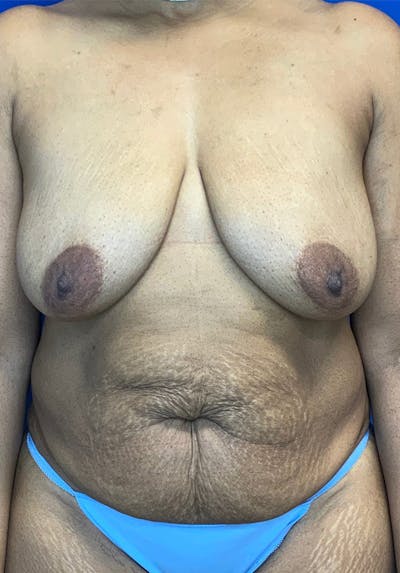Tummy Tuck (Abdominoplasty) Before & After Gallery - Patient 144562394 - Image 1