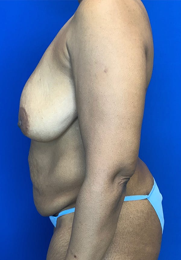 Mastopexy Before & After Gallery - Patient 144562393 - Image 3