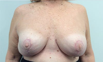 Breast Implant Removal and Replacement Before & After Gallery - Patient 146343752 - Image 2