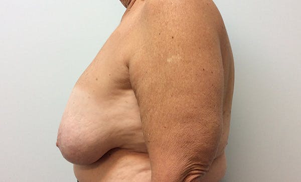 Mastopexy Before & After Gallery - Patient 146343753 - Image 3
