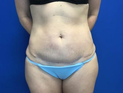 Liposuction Before & After Gallery - Patient 146559417 - Image 2