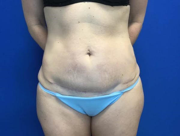 Tummy Tuck (Abdominoplasty) Before & After Gallery - Patient 146559418 - Image 2