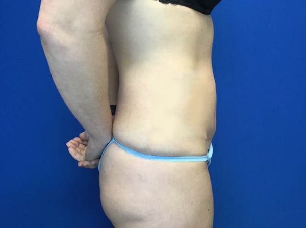 Liposuction Before & After Gallery - Patient 146559417 - Image 4