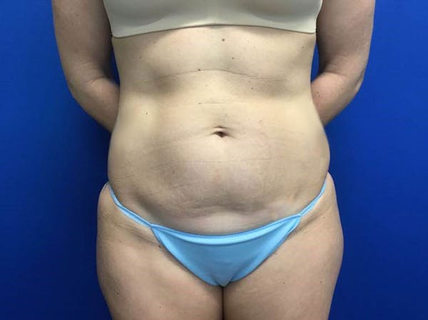 Liposuction Before & After Gallery - Patient 146559417 - Image 1