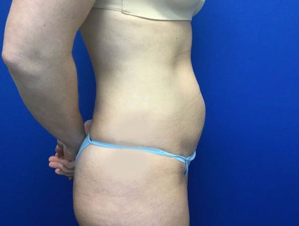 Tummy Tuck (Abdominoplasty) Before & After Gallery - Patient 146559418 - Image 3