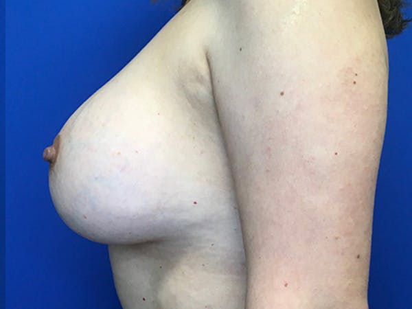 Mastopexy Before & After Gallery - Patient 146779364 - Image 9