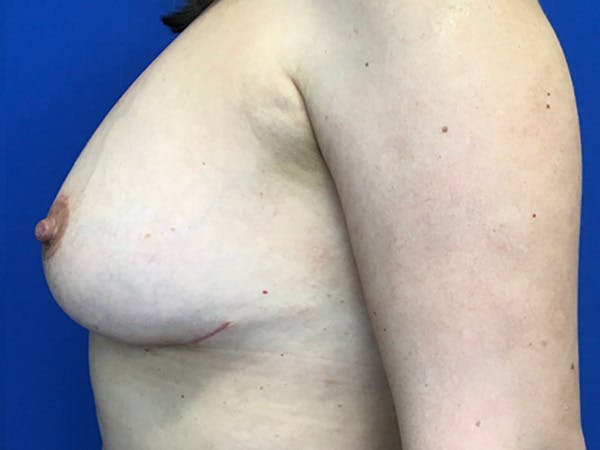 Mastopexy Before & After Gallery - Patient 146779364 - Image 10
