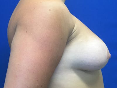 Mastopexy Before & After Gallery - Patient 146990775 - Image 4
