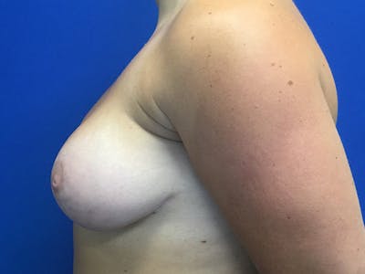 Breast Augmentation Before & After Gallery - Patient 146990764 - Image 6