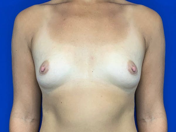 Breast Augmentation Before & After Gallery - Patient 147393272 - Image 1