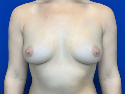 Breast Augmentation Before & After Gallery - Patient 147393272 - Image 2