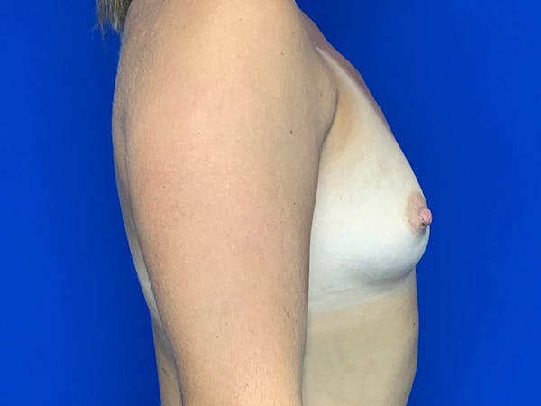 Breast Augmentation Before & After Gallery - Patient 147393272 - Image 3