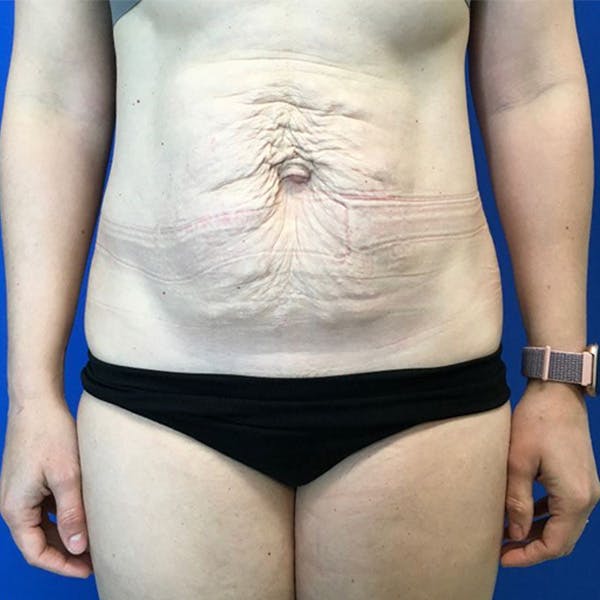 Tummy Tuck (Abdominoplasty) Before & After Gallery - Patient 147494674 - Image 1