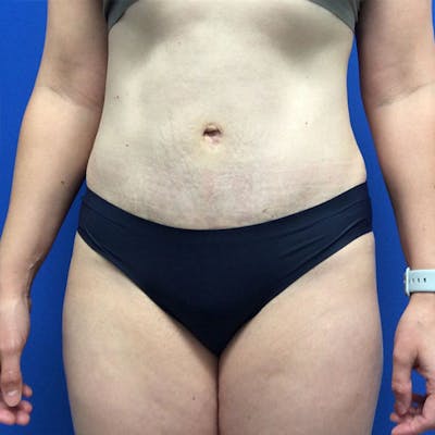 Tummy Tuck (Abdominoplasty) Before & After Gallery - Patient 147494674 - Image 2