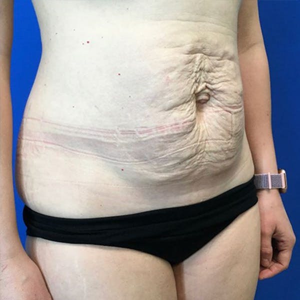 Tummy Tuck (Abdominoplasty) Before & After Gallery - Patient 147494674 - Image 3