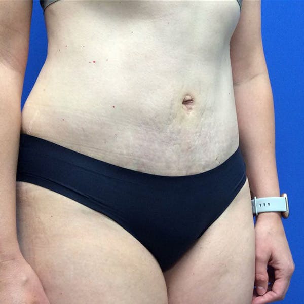 Tummy Tuck (Abdominoplasty) Before & After Gallery - Patient 147494674 - Image 4