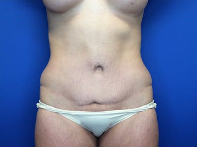 Liposuction Before & After Gallery - Patient 147775342 - Image 1